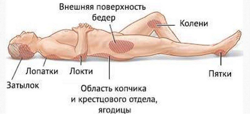 Как распознать появление пролежней?