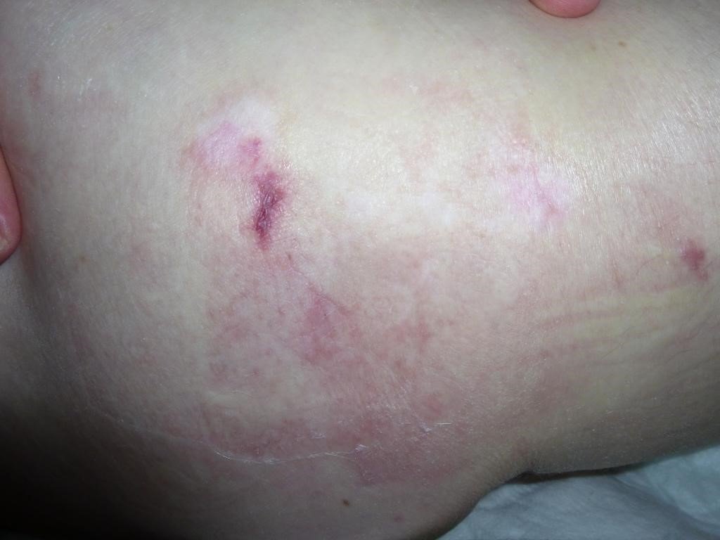 Как распознать появление пролежней?