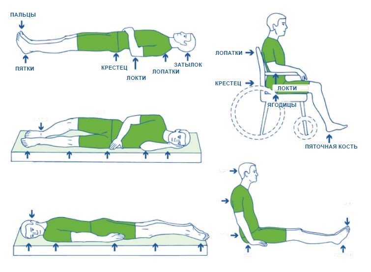 Лечение и профилактика пролежней